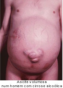 Cancer liquido abdominal, Pancreatic Cancer - Nucleus Health papillomavirus homme preservatif