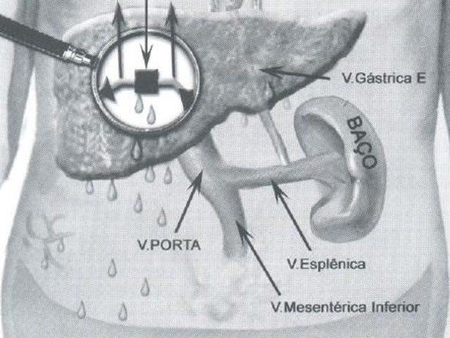 Cirrose do Fígado